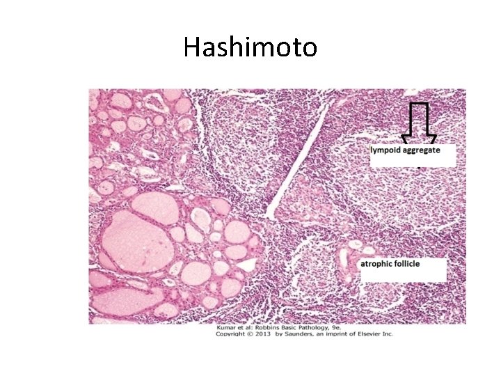 Hashimoto 