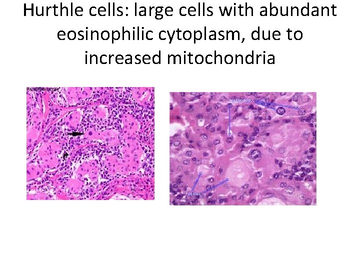 Hurthle cells: large cells with abundant eosinophilic cytoplasm, due to increased mitochondria 