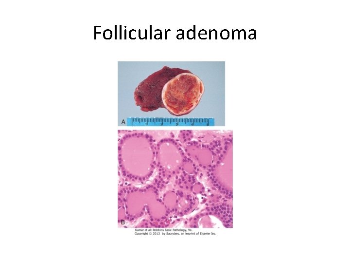 Follicular adenoma 