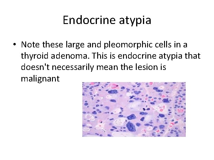Endocrine atypia • Note these large and pleomorphic cells in a thyroid adenoma. This