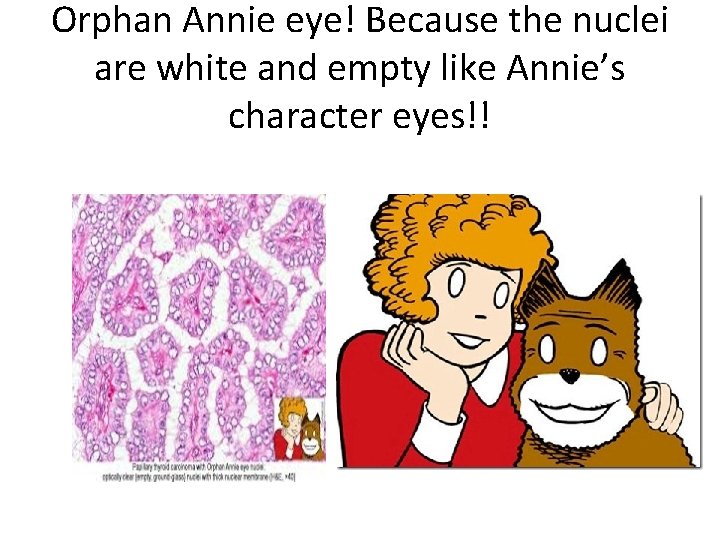 Orphan Annie eye! Because the nuclei are white and empty like Annie’s character eyes!!