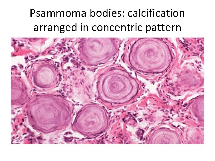 Psammoma bodies: calcification arranged in concentric pattern 