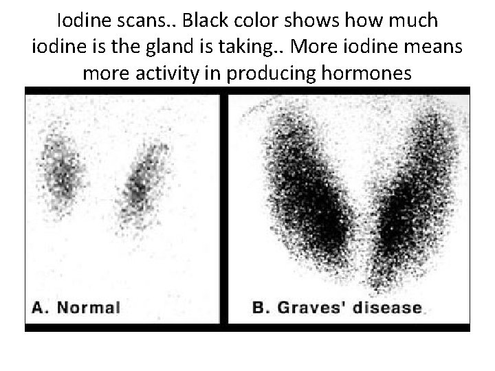 Iodine scans. . Black color shows how much iodine is the gland is taking.