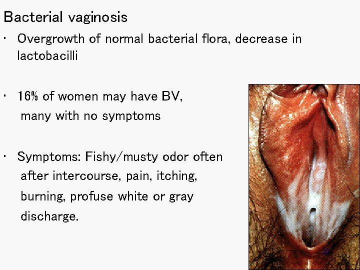 Bacterial vaginosis • Overgrowth of normal bacterial flora, decrease in lactobacilli • 16% of