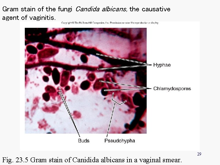 Gram stain of the fungi Candida albicans, the causative agent of vaginitis. Fig. 23.