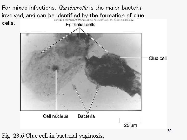 For mixed infections, Gardnerella is the major bacteria involved, and can be identified by