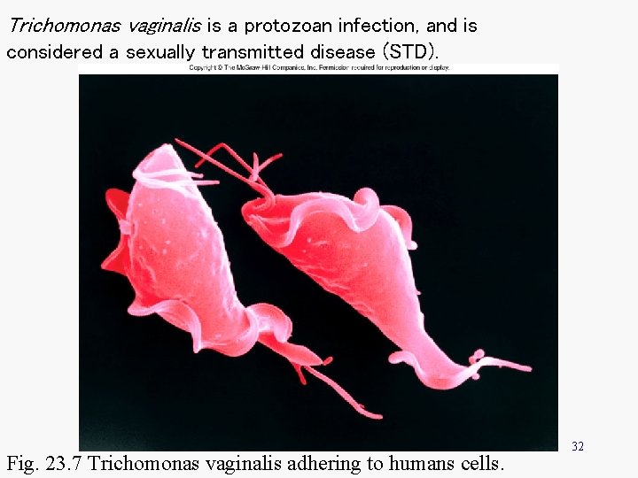 Trichomonas vaginalis is a protozoan infection, and is considered a sexually transmitted disease (STD).