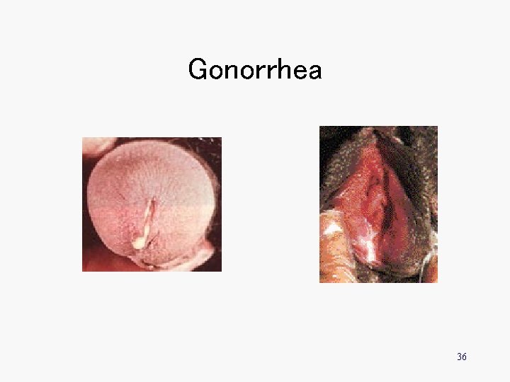 Gonorrhea 36 