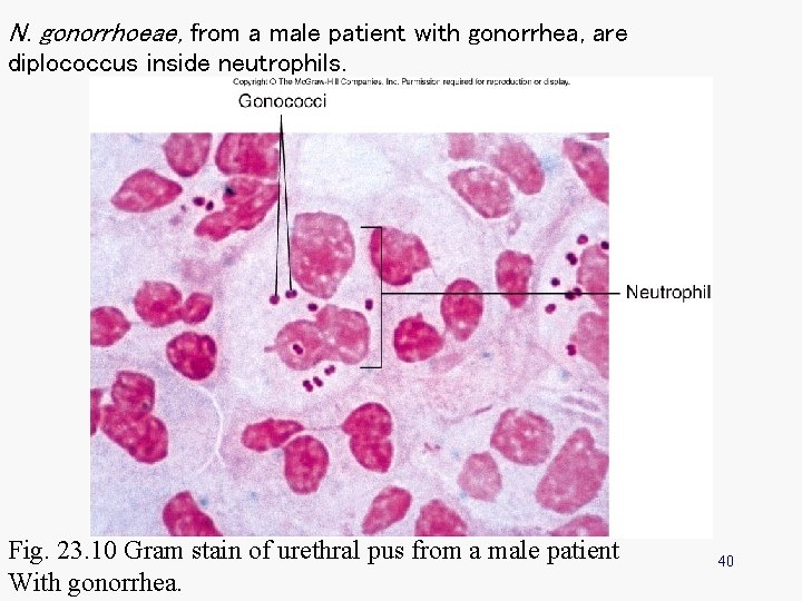 N. gonorrhoeae, from a male patient with gonorrhea, are diplococcus inside neutrophils. Fig. 23.