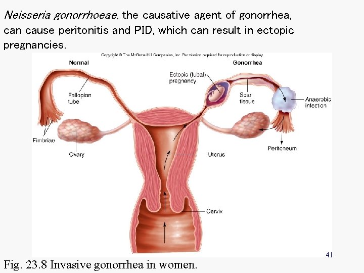 Neisseria gonorrhoeae, the causative agent of gonorrhea, can cause peritonitis and PID, which can