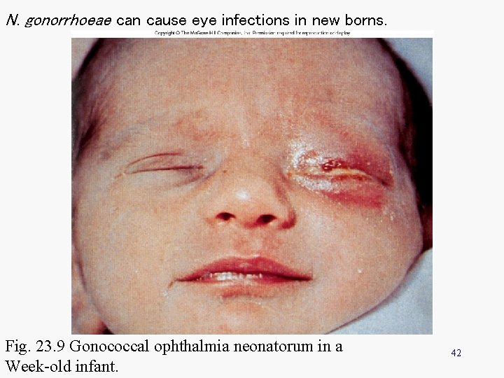 N. gonorrhoeae can cause eye infections in new borns. Fig. 23. 9 Gonococcal ophthalmia