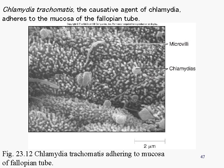 Chlamydia trachomatis, the causative agent of chlamydia, adheres to the mucosa of the fallopian