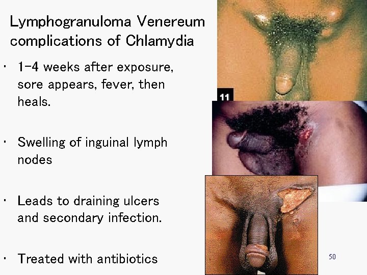 Lymphogranuloma Venereum complications of Chlamydia • 1 -4 weeks after exposure, sore appears, fever,