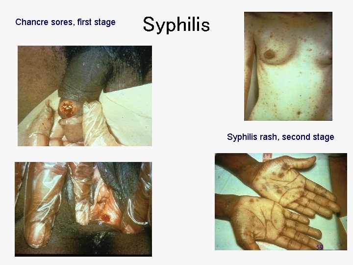 Chancre sores, first stage Syphilis rash, second stage 59 