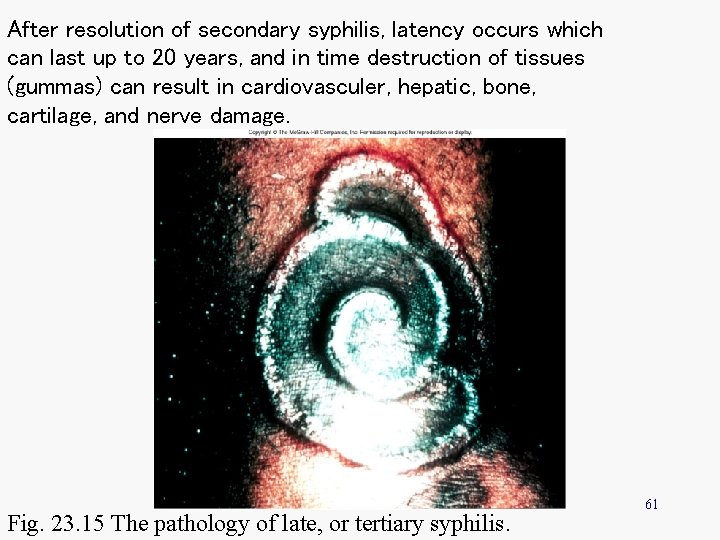 After resolution of secondary syphilis, latency occurs which can last up to 20 years,