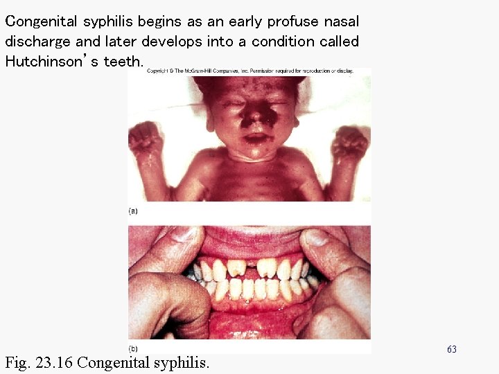 Congenital syphilis begins as an early profuse nasal discharge and later develops into a