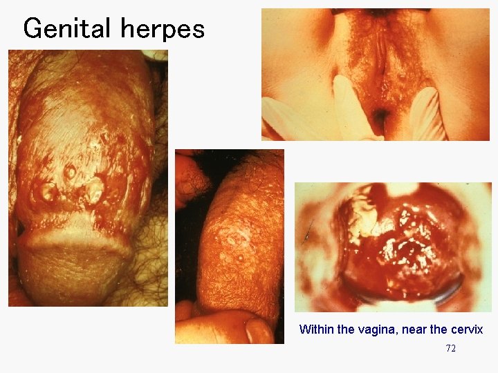 Genital herpes Within the vagina, near the cervix 72 