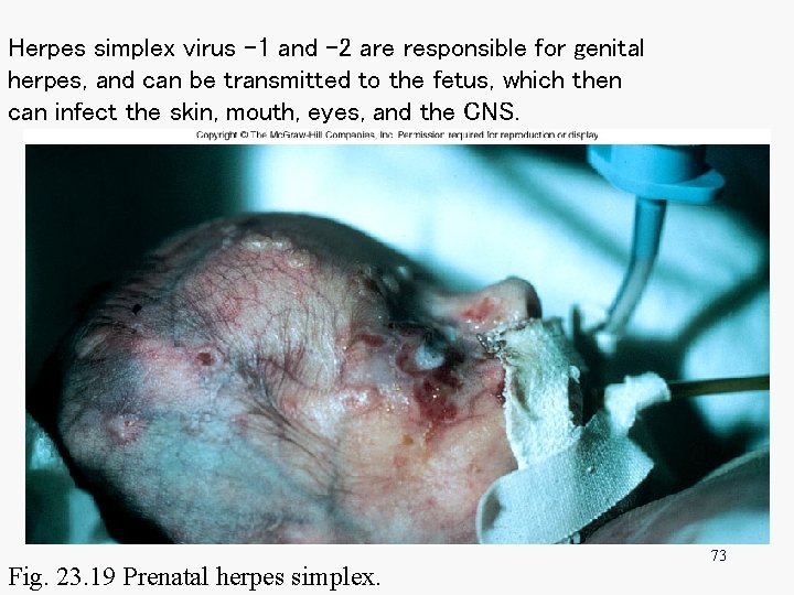 Herpes simplex virus -1 and – 2 are responsible for genital herpes, and can