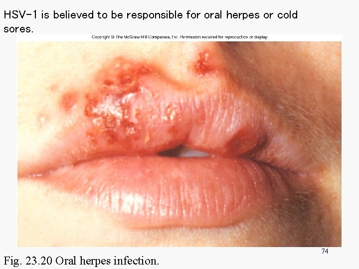 HSV-1 is believed to be responsible for oral herpes or cold sores. Fig. 23.