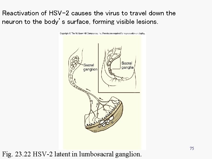 Reactivation of HSV-2 causes the virus to travel down the neuron to the body’s