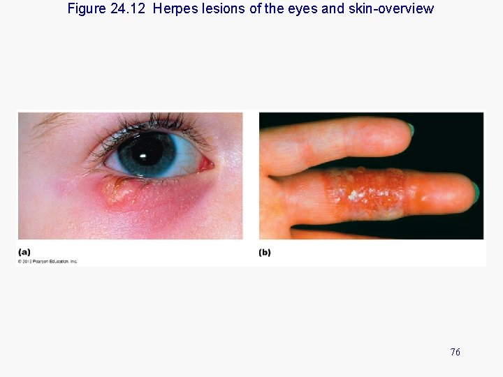 Figure 24. 12 Herpes lesions of the eyes and skin-overview 76 