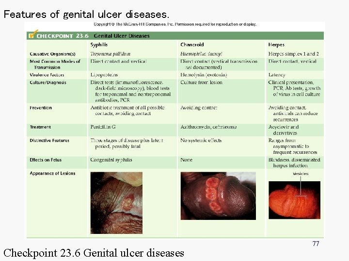 Features of genital ulcer diseases. Checkpoint 23. 6 Genital ulcer diseases 77 