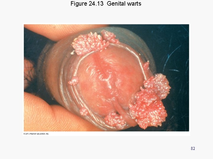 Figure 24. 13 Genital warts 82 