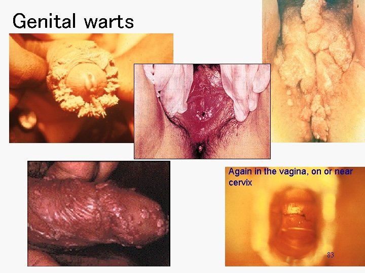 Genital warts Again in the vagina, on or near cervix 83 