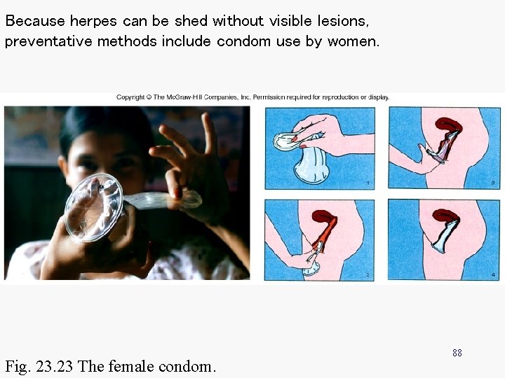Because herpes can be shed without visible lesions, preventative methods include condom use by