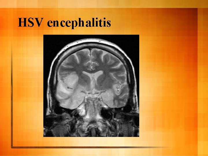 HSV encephalitis 