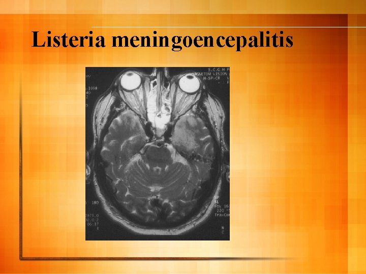 Listeria meningoencepalitis 
