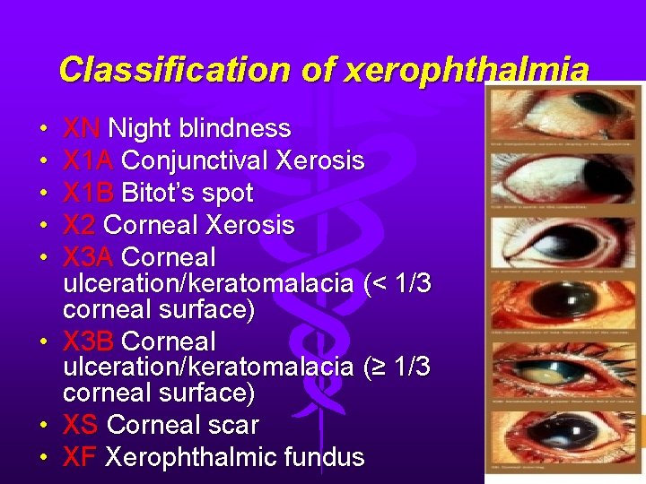 Classification of xerophthalmia • • • XN Night blindness X 1 A Conjunctival Xerosis