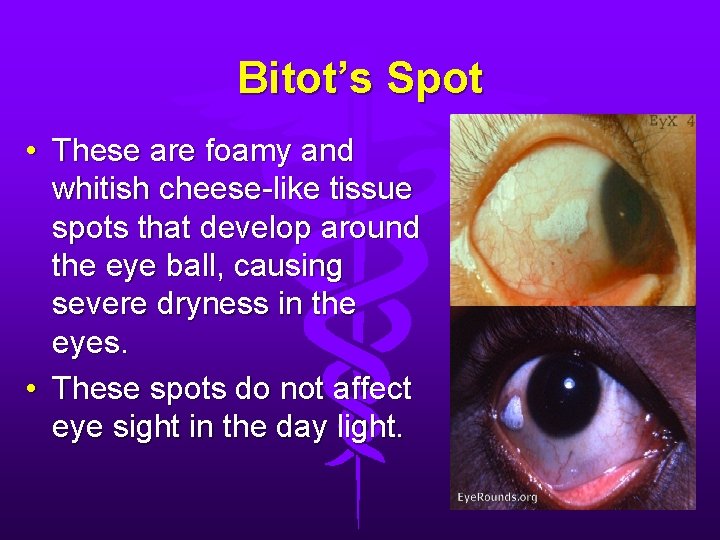 Bitot’s Spot • These are foamy and whitish cheese-like tissue spots that develop around