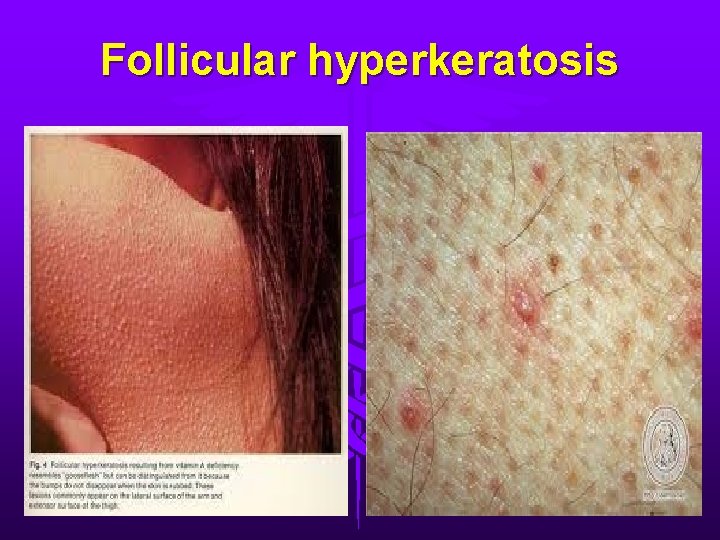 Follicular hyperkeratosis 