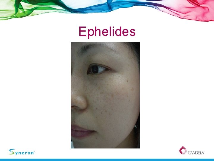 Ephelides 