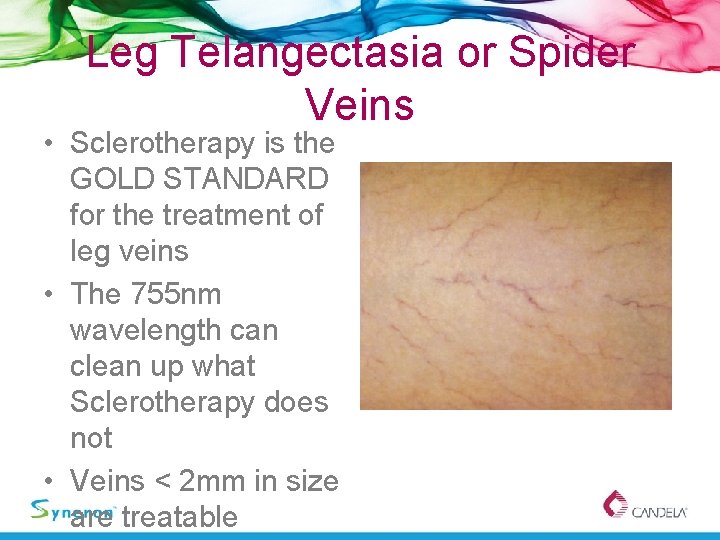Leg Telangectasia or Spider Veins • Sclerotherapy is the GOLD STANDARD for the treatment