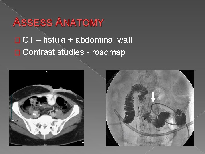 ASSESS ANATOMY � CT – fistula + abdominal wall � Contrast studies - roadmap