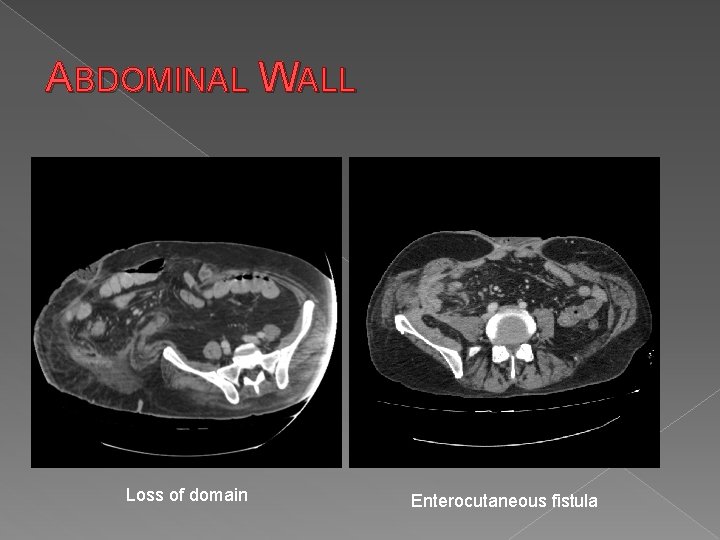 ABDOMINAL WALL Loss of domain Enterocutaneous fistula 