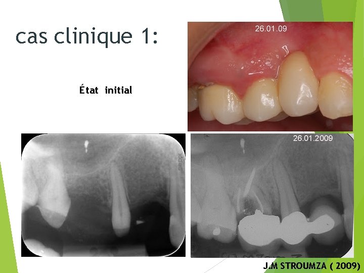 cas clinique 1: État initial Radio pré-opératoire J. M STROUMZA ( 2009) 