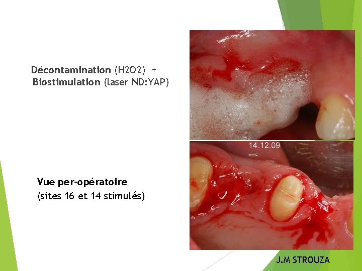 Décontamination (H 2 O 2) + Biostimulation (laser ND: YAP) Vue per-opératoire (sites 16