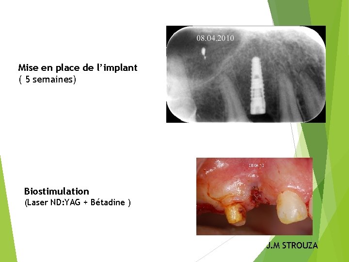 Mise en place de l’implant ( 5 semaines) Biostimulation (Laser ND: YAG + Bétadine