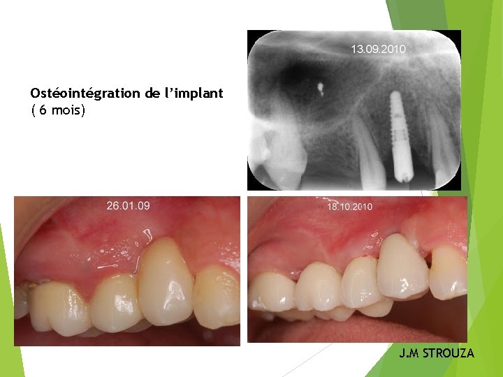 Ostéointégration de l’implant ( 6 mois) Résultat final J. M STROUZA 