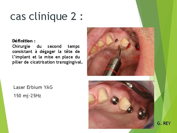 cas clinique 2 : Définition : Chirurgie du second temps consistant à dégager la