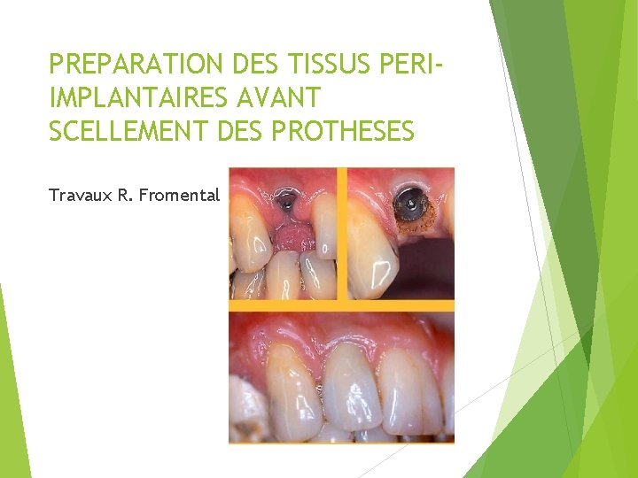 PREPARATION DES TISSUS PERIIMPLANTAIRES AVANT SCELLEMENT DES PROTHESES Travaux R. Fromental 