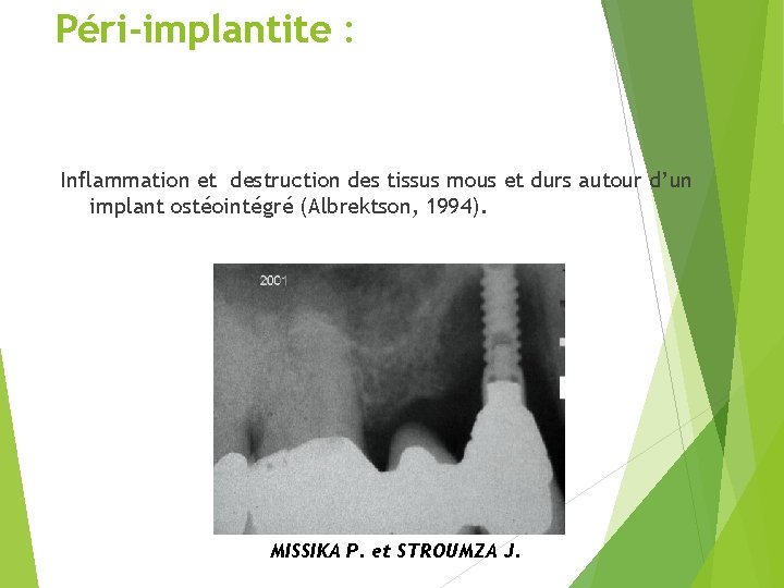 Péri-implantite : Inflammation et destruction des tissus mous et durs autour d’un implant ostéointégré