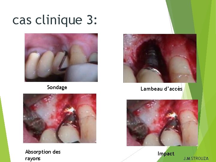 cas clinique 3: Sondage Absorption des rayons Lambeau d’accès Impact J. M STROUZA 
