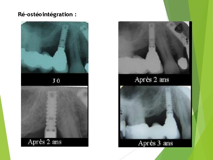 Ré-ostéointégration : 