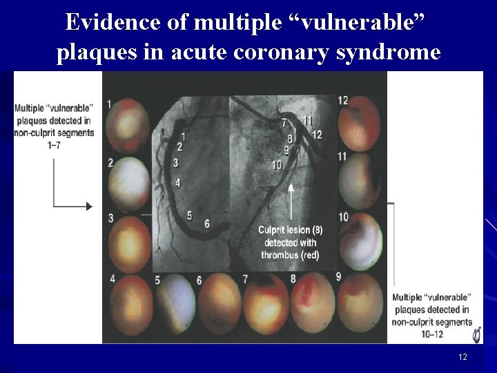 Evidence of multiple “vulnerable” plaques in acute coronary syndrome 12 