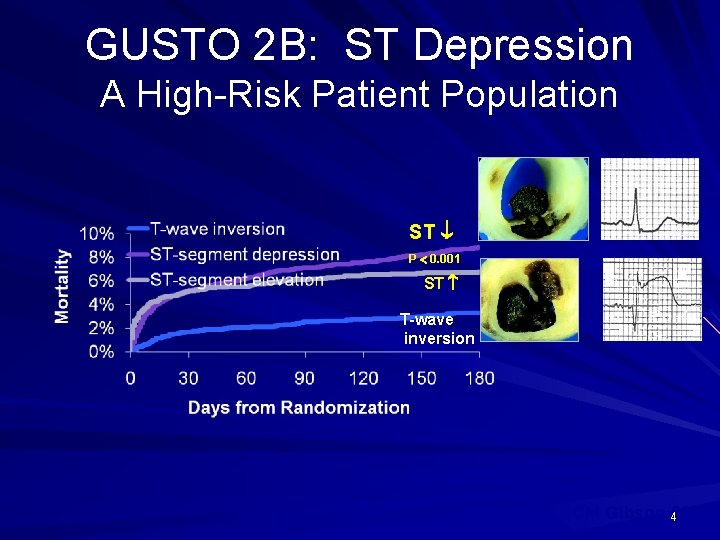 GUSTO 2 B: ST Depression A High-Risk Patient Population ST P 0. 001 ST