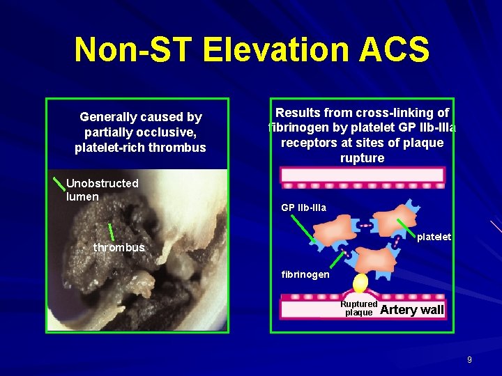 Non-ST Elevation ACS Generally caused by partially occlusive, platelet-rich thrombus Unobstructed lumen Results from